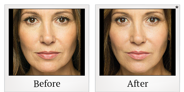 Before and After Photo 4 of Belotero Balance® treatment at SF Bay Cosmetic Surgery Medical Group in San Ramon