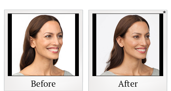 Before and After Photo 1 of Botox® treatment at SF Bay Cosmetic Surgery Medical Group in San Ramon