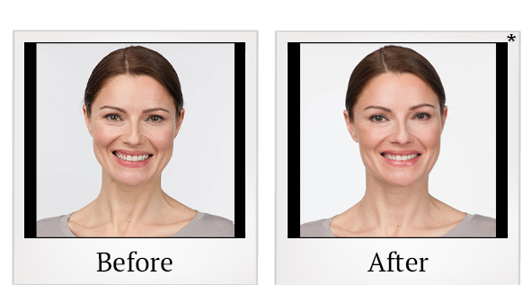 Before and After Photo 2 of Botox® treatment at SF Bay Cosmetic Surgery Medical Group in San Ramon
