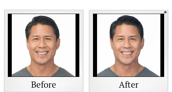 Before and After Photo 3 of Botox® treatment at SF Bay Cosmetic Surgery Medical Group in San Ramon