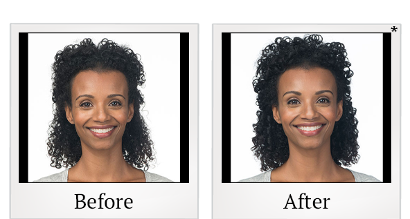 Before and After Photo 4 of Botox® treatment at SF Bay Cosmetic Surgery Medical Group in San Ramon