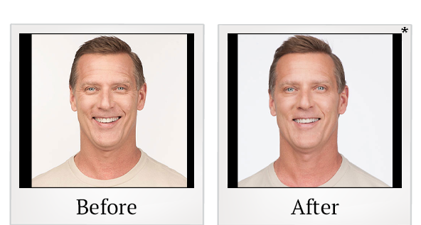 Before and After Photo 5 of Botox® treatment at SF Bay Cosmetic Surgery Medical Group in San Ramon