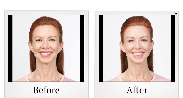 Before and After Photo 6 of Botox® treatment at SF Bay Cosmetic Surgery Medical Group in San Ramon