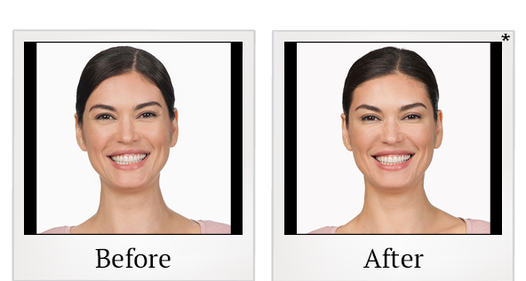 Before and After Photo 7 of Botox® treatment at SF Bay Cosmetic Surgery Medical Group in San Ramon