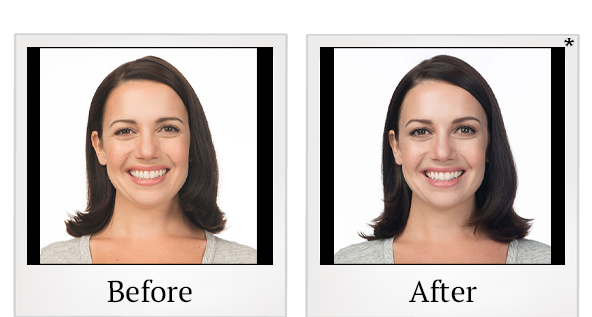 Before and After Photo 8 of Botox® treatment at SF Bay Cosmetic Surgery Medical Group in San Ramon