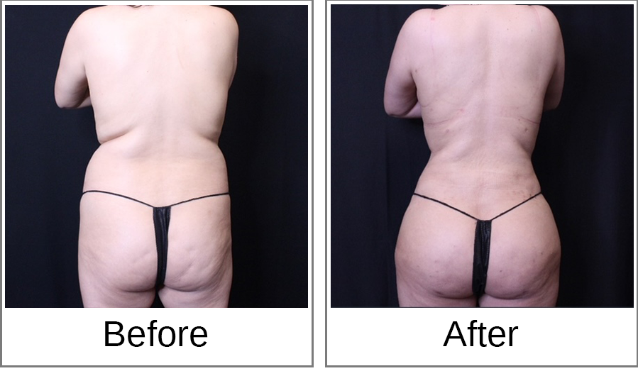 Before and After Photo 1 of Brazilian Butt Lift treatment at SF Bay Cosmetic Surgery Medical Group in San Ramon