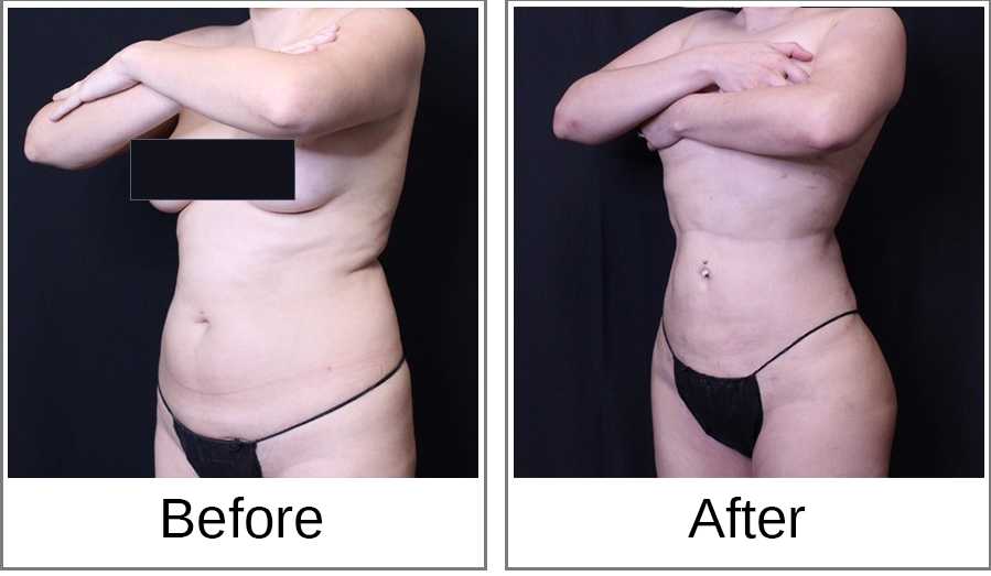 Before and After Photo 2 of Brazilian Butt Lift treatment at SF Bay Cosmetic Surgery Medical Group in San Ramon