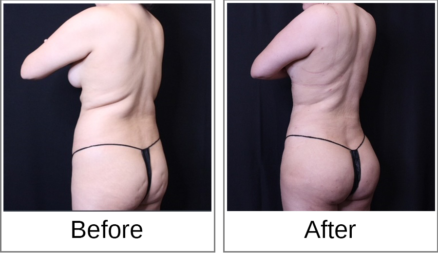 Before and After Photo 3 of Brazilian Butt Lift treatment at SF Bay Cosmetic Surgery Medical Group in San Ramon