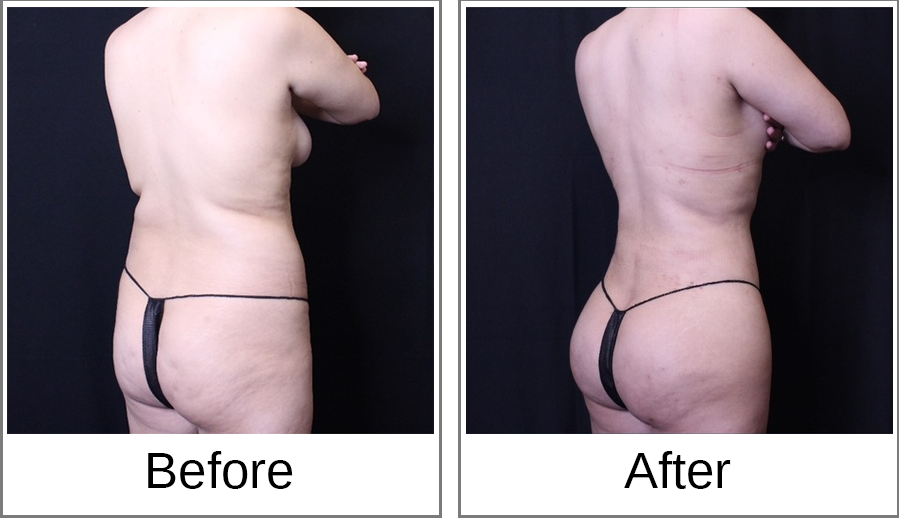 Before and After Photo 4 of Brazilian Butt Lift treatment at SF Bay Cosmetic Surgery Medical Group in San Ramon