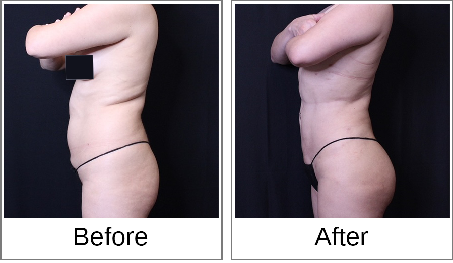Before and After Photo 5 of Brazilian Butt Lift treatment at SF Bay Cosmetic Surgery Medical Group in San Ramon