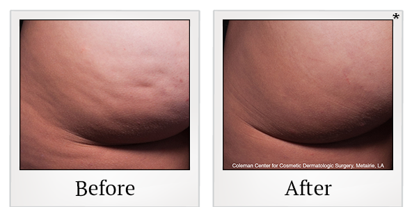 Before and After Photo 1 of Cellfina® treatment at SF Bay Cosmetic Surgery Medical Group in San Ramon