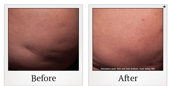 Before and After Photo 2 of Cellfina® treatment at SF Bay Cosmetic Surgery Medical Group in San Ramon