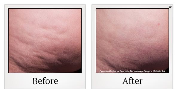 Before and After Photo 3 of Cellfina® treatment at SF Bay Cosmetic Surgery Medical Group in San Ramon