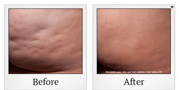 Before and After Photo 4 of Cellfina® treatment at SF Bay Cosmetic Surgery Medical Group in San Ramon