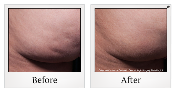 Before and After Photo 5 of Cellfina® treatment at SF Bay Cosmetic Surgery Medical Group in San Ramon