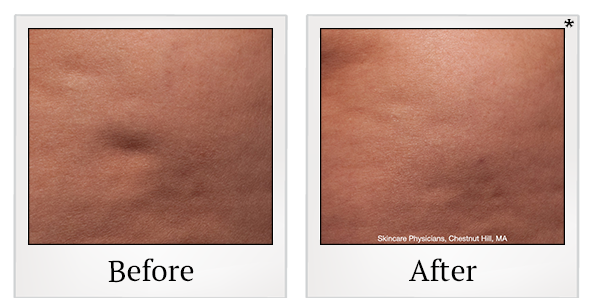 Before and After Photo 6 of Cellfina® treatment at SF Bay Cosmetic Surgery Medical Group in San Ramon