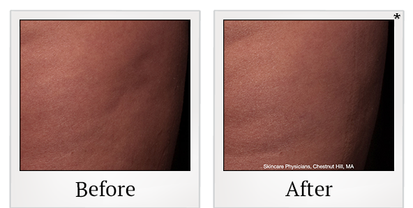 Before and After Photo 7 of Cellfina® treatment at SF Bay Cosmetic Surgery Medical Group in San Ramon