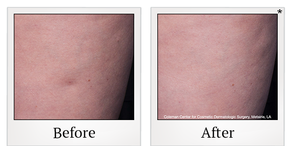 Before and After Photo 8 of Cellfina® treatment at SF Bay Cosmetic Surgery Medical Group in San Ramon
