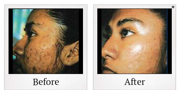 Before and After Photo 1 of Chemical Peel treatment at SF Bay Cosmetic Surgery Medical Group in San Ramon