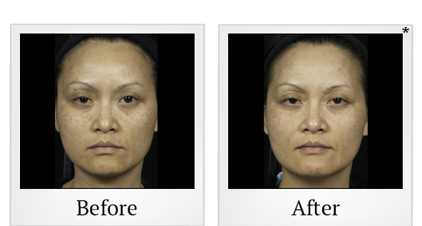 Before and After Photo 2 of Clear + Brilliant® treatment at SF Bay Cosmetic Surgery Medical Group in San Ramon