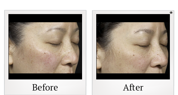 Before and After Photo 3 of Clear + Brilliant® treatment at SF Bay Cosmetic Surgery Medical Group in San Ramon