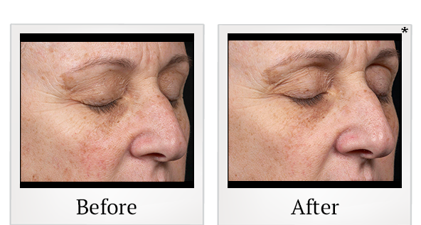 Before and After Photo 4 of Clear + Brilliant® treatment at SF Bay Cosmetic Surgery Medical Group in San Ramon