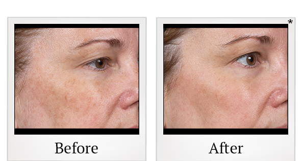 Before and After Photo 5 of Clear + Brilliant® treatment at SF Bay Cosmetic Surgery Medical Group in San Ramon