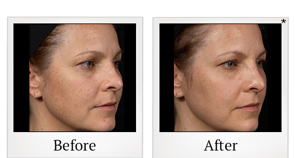 Before and After Photo 6 of Clear + Brilliant® treatment at SF Bay Cosmetic Surgery Medical Group in San Ramon