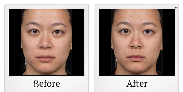 Before and After Photo 1 of Clear + Brilliant® treatment at SF Bay Cosmetic Surgery Medical Group in San Ramon
