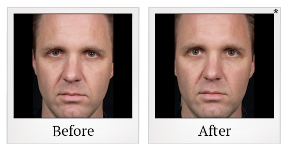 Before and After Photo 2 of Clear + Brilliant® treatment at SF Bay Cosmetic Surgery Medical Group in San Ramon