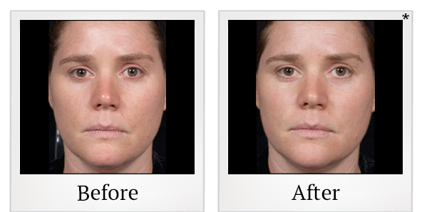 Before and After Photo 3 of Clear + Brilliant® treatment at SF Bay Cosmetic Surgery Medical Group in San Ramon