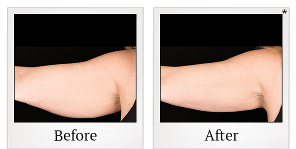 Before and After Photo 1 of Coolsculpting® treatment at SF Bay Cosmetic Surgery Medical Group in San Ramon