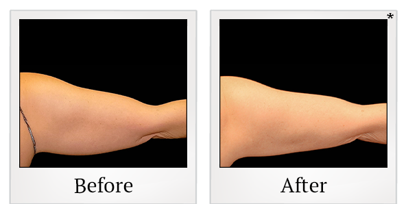 Before and After Photo 10 of Coolsculpting® treatment at SF Bay Cosmetic Surgery Medical Group in San Ramon