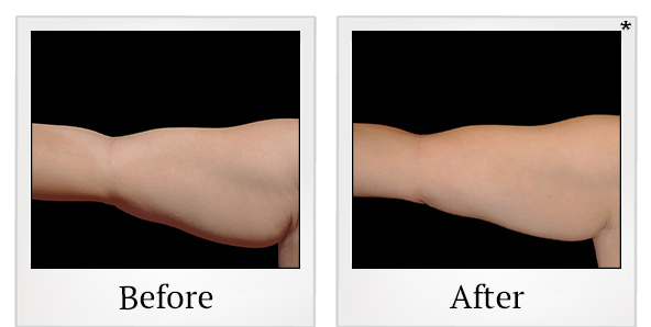 Before and After Photo 11 of Coolsculpting® treatment at SF Bay Cosmetic Surgery Medical Group in San Ramon