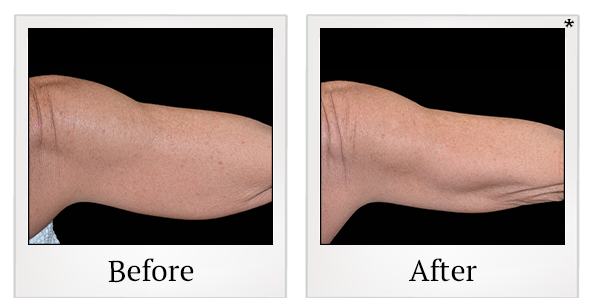 Before and After Photo 12 of Coolsculpting® treatment at SF Bay Cosmetic Surgery Medical Group in San Ramon