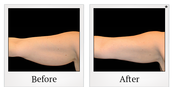 Before and After Photo 13 of Coolsculpting® treatment at SF Bay Cosmetic Surgery Medical Group in San Ramon