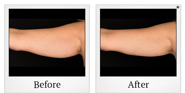 Before and After Photo 14 of Coolsculpting® treatment at SF Bay Cosmetic Surgery Medical Group in San Ramon