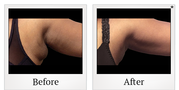 Before and After Photo 15 of Coolsculpting® treatment at SF Bay Cosmetic Surgery Medical Group in San Ramon