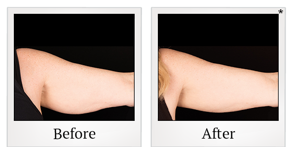 Before and After Photo 2 of Coolsculpting® treatment at SF Bay Cosmetic Surgery Medical Group in San Ramon