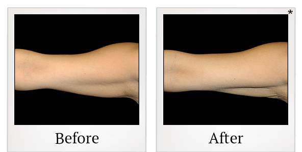 Before and After Photo 3 of Coolsculpting® treatment at SF Bay Cosmetic Surgery Medical Group in San Ramon