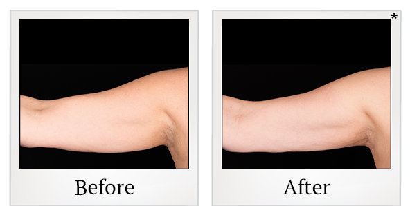Before and After Photo 4 of Coolsculpting® treatment at SF Bay Cosmetic Surgery Medical Group in San Ramon