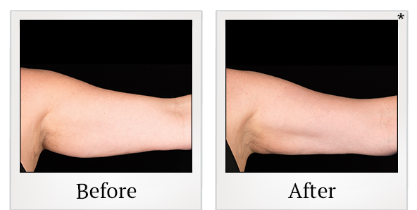 Before and After Photo 5 of Coolsculpting® treatment at SF Bay Cosmetic Surgery Medical Group in San Ramon