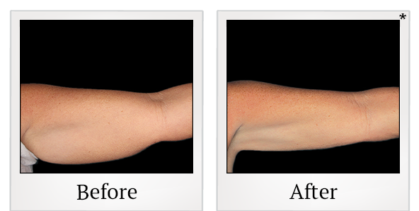 Before and After Photo 6 of Coolsculpting® treatment at SF Bay Cosmetic Surgery Medical Group in San Ramon