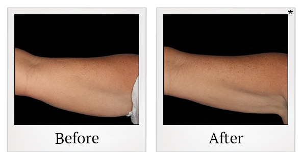 Before and After Photo 7 of Coolsculpting® treatment at SF Bay Cosmetic Surgery Medical Group in San Ramon