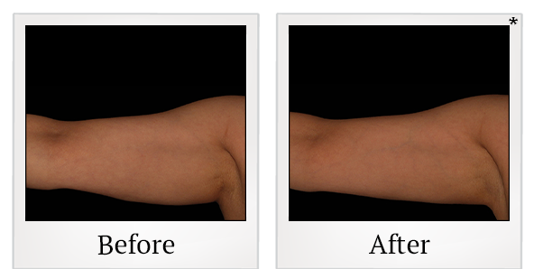 Before and After Photo 8 of Coolsculpting® treatment at SF Bay Cosmetic Surgery Medical Group in San Ramon