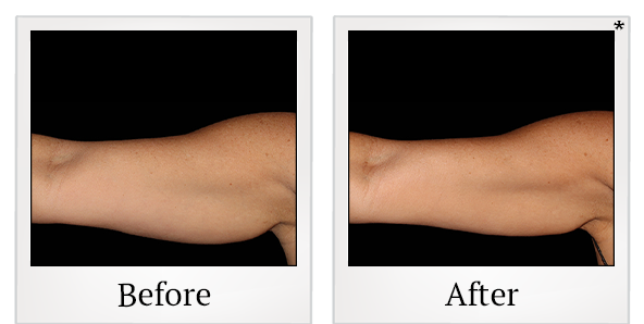 Before and After Photo 9 of Coolsculpting® treatment at SF Bay Cosmetic Surgery Medical Group in San Ramon