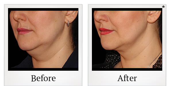 Before and After Photo 1 of Coolsculpting® treatment at SF Bay Cosmetic Surgery Medical Group in San Ramon