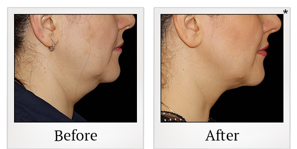 Before and After Photo 2 of Coolsculpting® treatment at SF Bay Cosmetic Surgery Medical Group in San Ramon