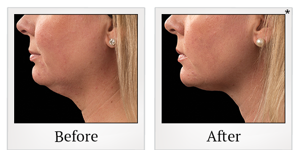 Before and After Photo 3 of Coolsculpting® treatment at SF Bay Cosmetic Surgery Medical Group in San Ramon