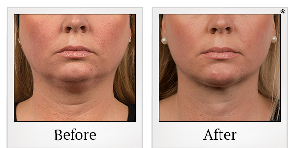Before and After Photo 4 of Coolsculpting® treatment at SF Bay Cosmetic Surgery Medical Group in San Ramon